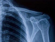 ฟิล์ม X-Ray นำมารีไซเคิลทำ เครื่องประดับ